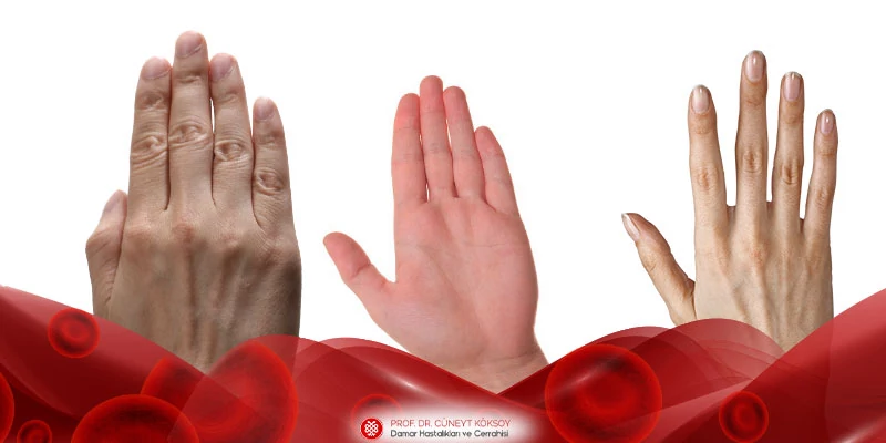 El Parmaklarının Damar Hastalıkları - Raynaud