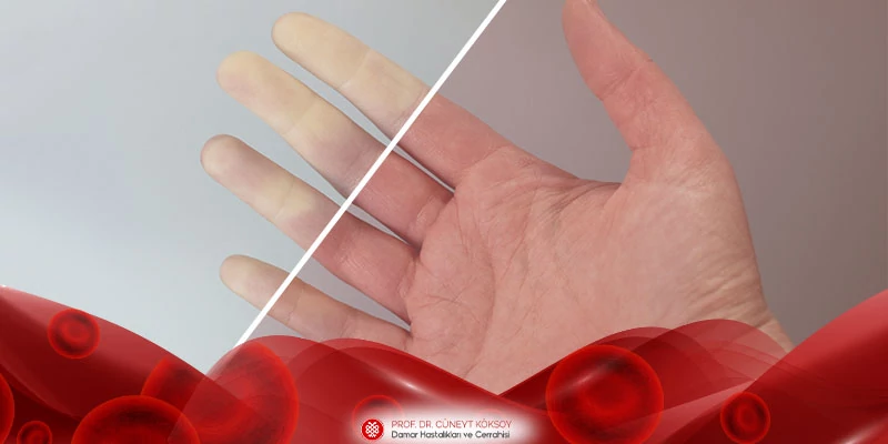 El Parmaklarının Damar Hastalıkları: Raynaud Hastalığı / Fenomeni