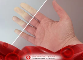 El Parmaklarının Damar Hastalıkları: Raynaud Hastalığı / Fenomeni