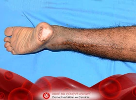 Popliteal Arter Tuzak/Kapan Sendromu